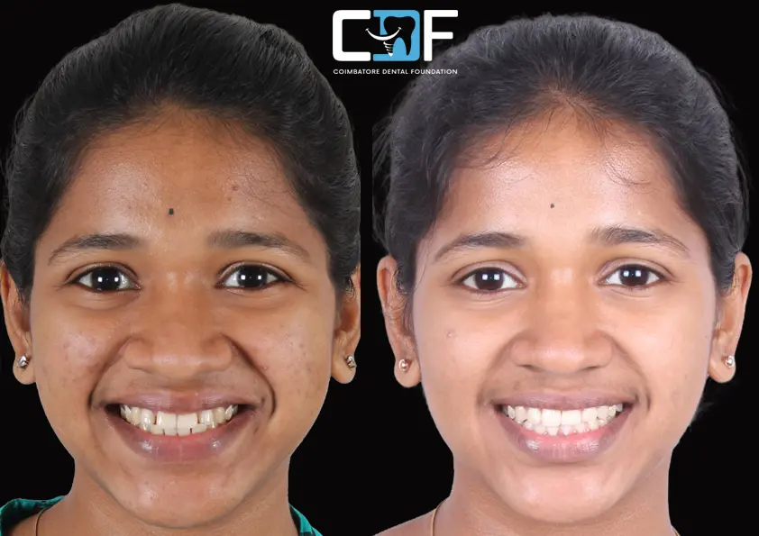 Dharshini Invisalign Before After